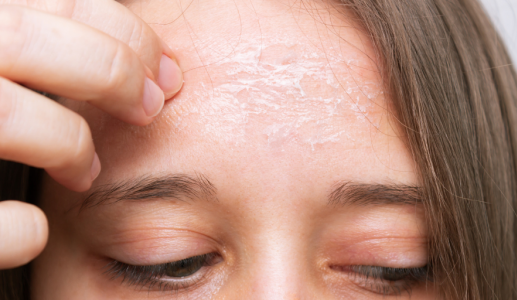 Nguyên nhân da mặt bị khô và cách cải thiện