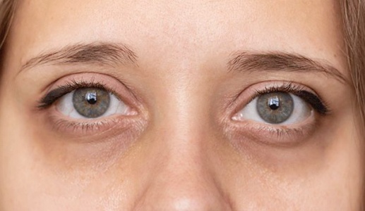 Có những cách nào giúp loại bỏ quầng thâm dưới mắt?
