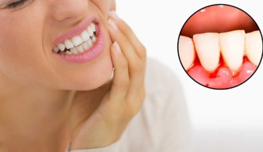 Cách cải thiện chảy máu nướu răng tại nhà