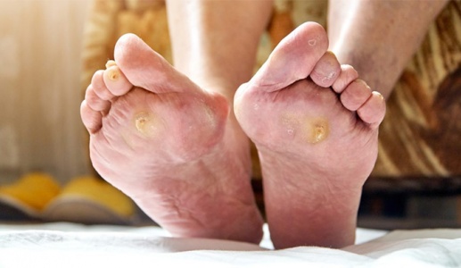 Đái tháo đường: 5 lời khuyên giúp phòng ngừa biến chứng loét bàn chân