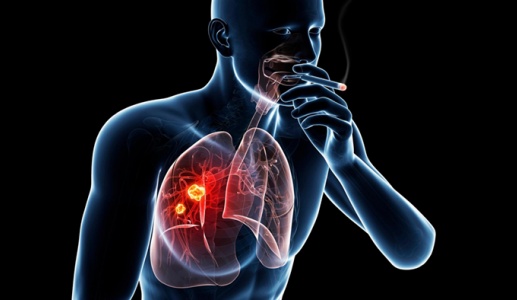 Yếu tố nguy cơ dẫn đến ung thư phổi biểu mô tuyến