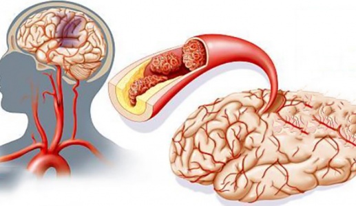 Thiếu máu não cục bộ: Dấu hiệu và cách cải thiện 