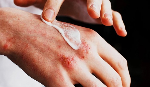 Biện pháp chăm sóc da tự nhiên cho người mắc bệnh chàm eczema