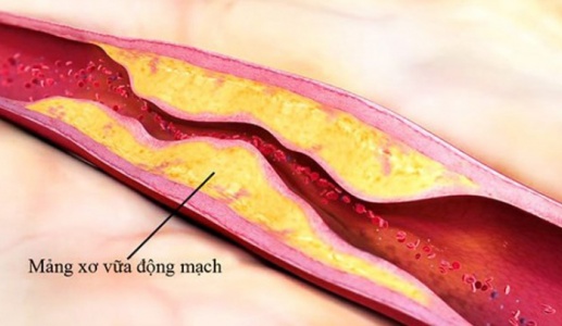 Xơ vữa động mạch gây ra biến chứng gì?