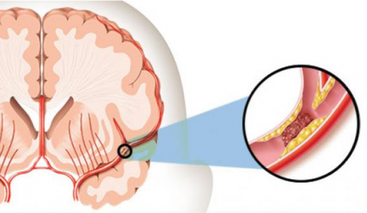 Nhận biết sớm dấu hiệu nhồi máu não