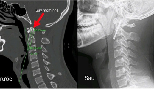 Hy vọng mới cho những người trẻ gặp chấn thương cột sống nghiêm trọng