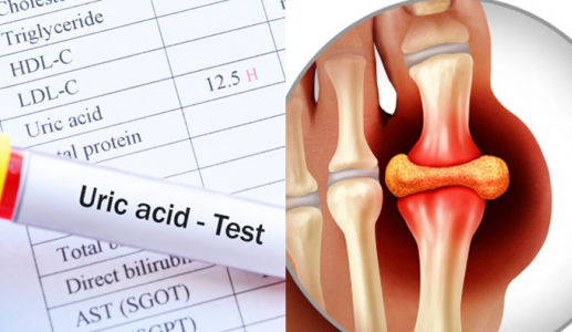 Dấu hiệu acid uric tăng cao và biện pháp kiểm soát