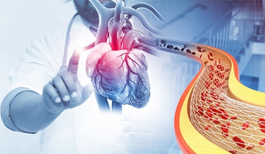 Bệnh mạch vành: Đặt stent sau bao lâu mới ổn định?