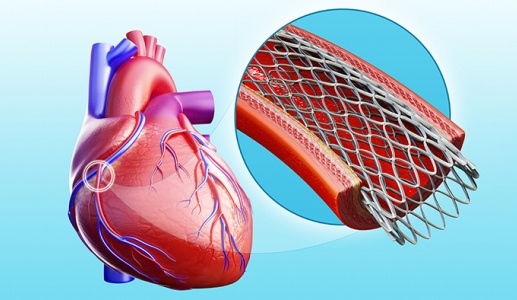 Chi phí phẫu thuật nong mạch vành hết bao nhiêu tiền?