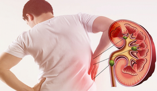 Nồng độ testosterone thấp làm tăng nguy cơ sỏi thận ở nam giới 