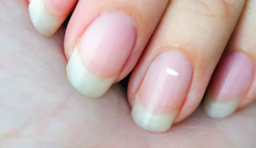 Đốm trắng xuất hiện trên móng tay do đâu?