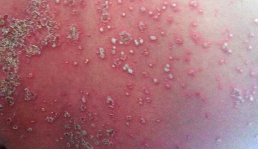 Mối lo ngại về bệnh vảy nến thể mủ