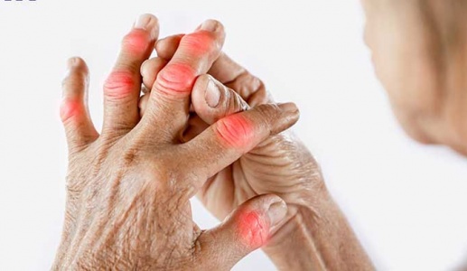 Thận trọng với những biến chứng nguy hiểm do bệnh gout gây ra