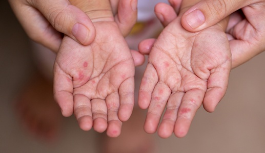Cách phòng bệnh tay chân miệng mùa Hè