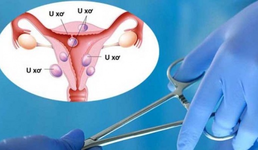 Nguyên nhân gây u xơ tử cung thường gặp