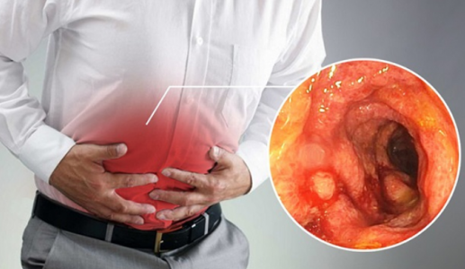 Phân biệt triệu chứng của viêm đại tràng và viêm loét đại tràng 