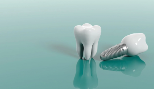 Khi nào nên thực hiện cấy ghép Implant cho răng?