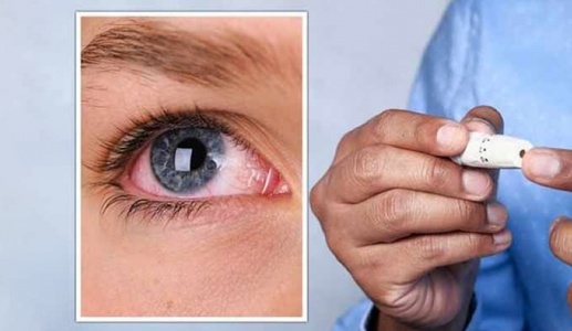 Đái tháo đường: Các thảo dược giúp cải thiện biến chứng mắt