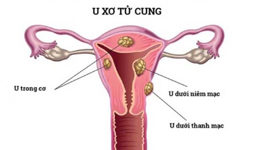 U xơ tử cung dưới niêm mạc có nguy hiểm không?