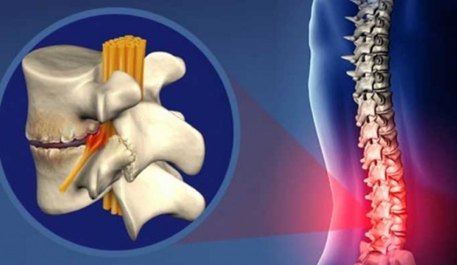 Hiểu về các giai đoạn thoái hóa cột sống