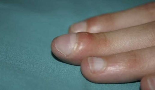 Dấu hiệu ở đầu ngón tay cảnh báo bệnh phổi 