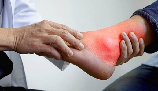 Chế độ ăn cho người bị đau gout cấp: Nên ăn và kiêng gì?