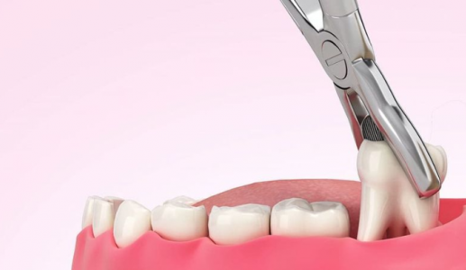 Những lầm tưởng phổ biến sau khi nhổ răng khôn 
