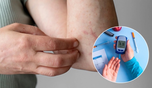 Người bệnh đái tháo đường bị ngứa da, càng gãi càng ngứa có nguy hiểm không?