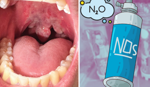 Cảnh báo nguy cơ bỏng lạnh khi lạm dụng khí N2O