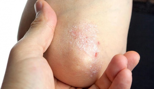 Hiểu về bệnh vảy nến và cách điều trị
