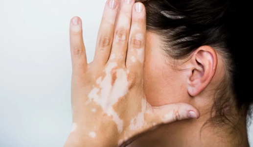 Những điều cần biết về bệnh bạch biến