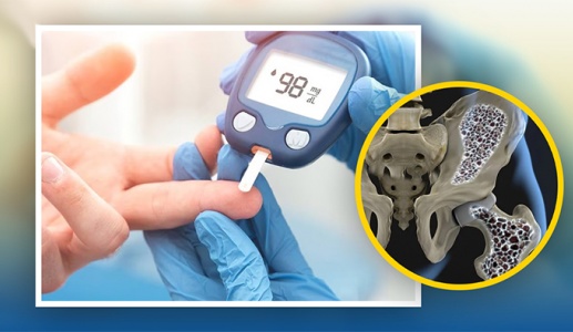 Đái tháo đường và loãng xương có mối liên hệ gì?