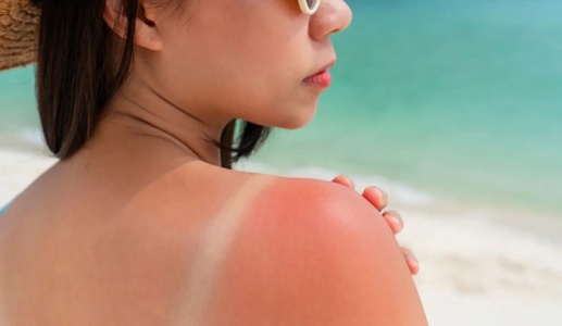 Mách bạn cách cải thiện cháy nắng hiệu quả
