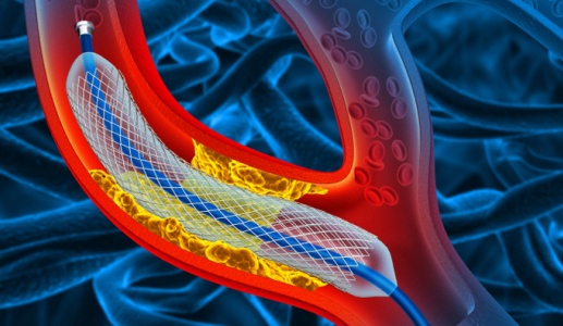 Đặt stent 2 tháng vẫn nhói ngực và mệt phải làm sao?