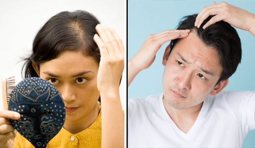 Hói đầu có đảo ngược được không?