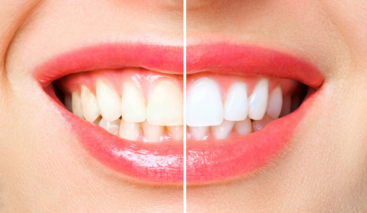 5 thói quen cần thay đổi để bảo vệ men răng và giữ nụ cười trắng sáng