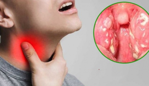 Khi bị viêm họng nên kiêng ăn gì?