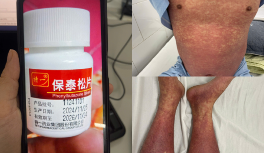 Người bệnh xương khớp cần cảnh giác với thuốc chống viêm Phenylbutazone