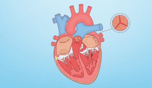 Hở van động mạch chủ 2/4, khó thở nên điều trị thế nào?