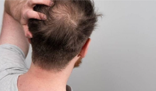Đồ uống có đường làm tăng nguy cơ rụng tóc?