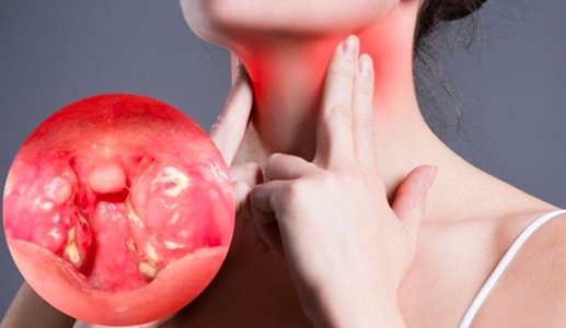 Người bị đau họng nên ăn gì để nhanh cải thiện?