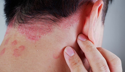 Làm sao để kiểm soát vảy nến mà không lệ thuộc thuốc?