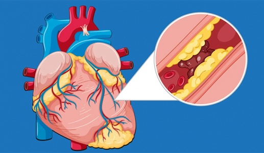 Động mạch vành bị hẹp 30 - 50%: Có cần đặt stent không?
