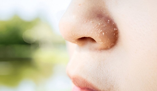 Mẹo hay giải cứu cho vùng da khô quanh mũi