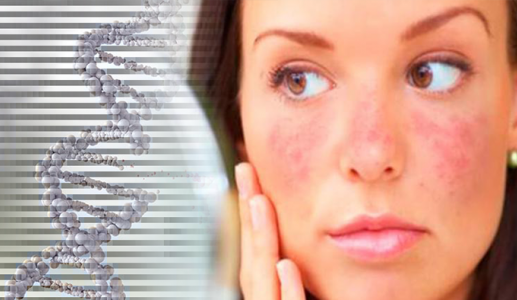 Yếu tố di truyền có ảnh hưởng đến bệnh lupus ban đỏ không?