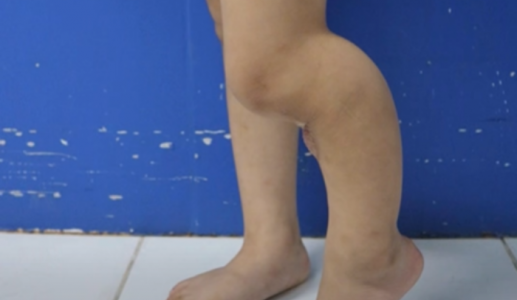 Có nên chữa gãy xương, viêm xương cho trẻ bằng cách đắp lá?	