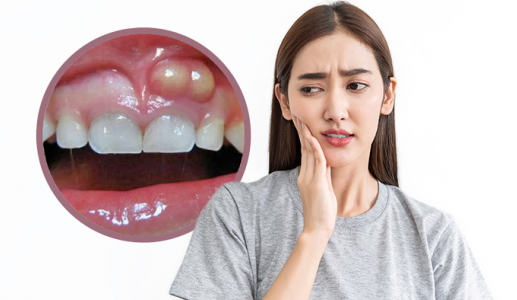 Bị viêm lợi có mủ liệu có tự khỏi được không?
