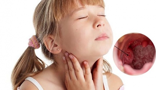 Biến chứng viêm amidan quá phát độ 4 ở trẻ em - Cha mẹ chớ chủ quan