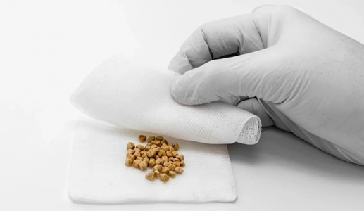 Có sỏi túi mật 5mm nên điều trị thế nào?