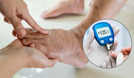Mắc đái tháo đường, bị sưng 2 chân là biến chứng gì?